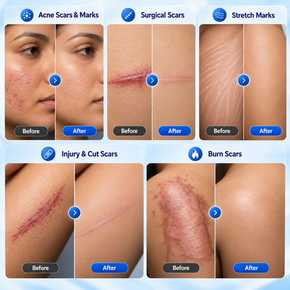 Scar Removal Cream & Silicone Gel | Advanced Scar Treatment for, Keloids & Stretch Marks (pack of 1)